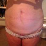 Gaining weight after tummy tuck image