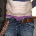 Gaining weight after tummy tuck patient photo