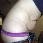 Gaining weight after tummy tuck photo