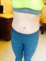 Getting pregnant after a tummy tuck photo