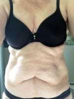 How much for tummy tuck image
