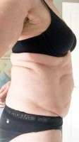How much for tummy tuck photo