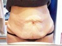 How much tummy tuck