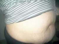 How much tummy tuck surgery