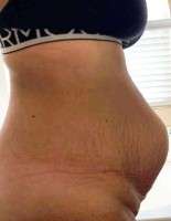 How much weight to lose before a tummy tuck