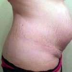 How much weight to lose before tummy tuck surgery