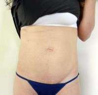 Image tummy tuck with c section