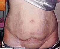 Images of weight loss after tummy tuck surgery