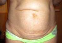 Images tummy tuck with c section