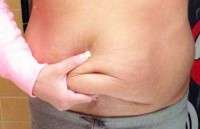 Medical reasons for tummy tuck picture