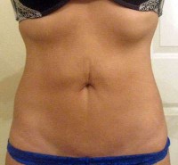 Mini tummy tuck abdominoplasty versus full