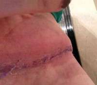 Numbness after tummy tuck image
