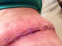 Numbness after tummy tuck images