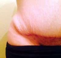 Numbness after tummy tuck operation