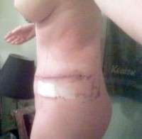 Numbness after tummy tuck patient photo