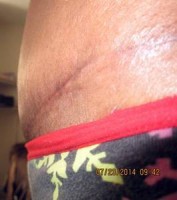 Numbness after tummy tuck abdominoplasty surgery photo
