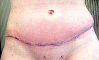 Numbness after tummy tuck surgery