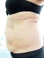 Photo candidate for tummy tuck