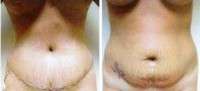 Photo of tummy tuck and c section