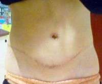 Photo swelling after tummy tuck and lipo