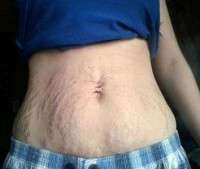 Photo tummy tuck for stretch marks