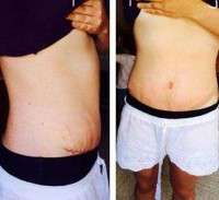 Photos weight loss after tummy tuck surgery
