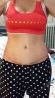 Picture of swelling after tummy tuck and lipo