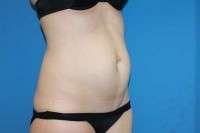 Picture of tummy tuck scars