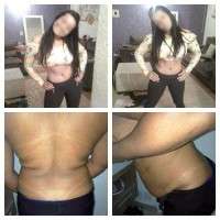 Picture of tummy tuck weight loss