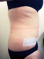 Picture swelling after tummy tuck and lipo
