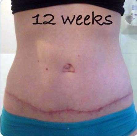 swelling after a tummy tuck photos
