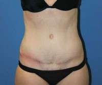 Pictures of tummy tuck scars after