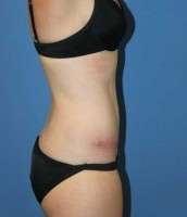Pictures of tummy tuck scars after surgery