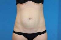 Pictures of tummy tuck scars before