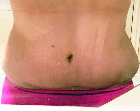 swelling after a tummy tuck photos