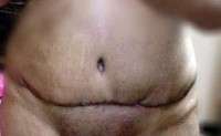 Post abdominoplasty scars
