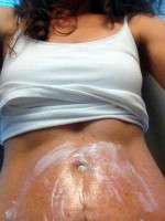 Post pregnancy tummy tuck photo
