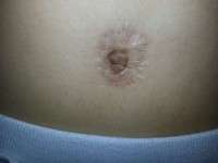 Post tummy tuck scars belly button