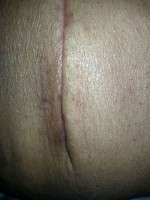 Post tummy tuck scars image