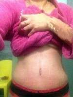 Pregnancy and tummy tuck and