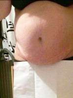Pregnant after abdominoplasty