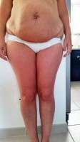 Pregnant after tummy tuck image