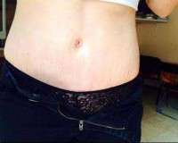 Pregnant after tummy tuck photo