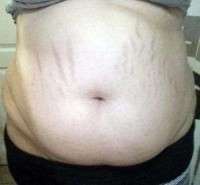 Pregnant after tummy tuck surgery