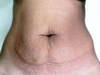 Price of a tummy tuck surgery