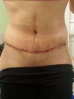 Recovery time for abdominoplasty