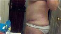 Recovery time for tummy tuck photo
