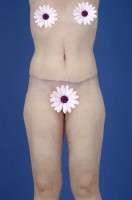 Reduce swelling after tummy tuck operation