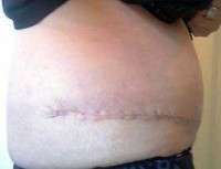 Reduce swelling after tummy tuck pictures