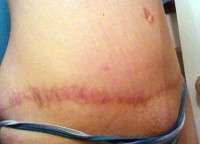 Scar after tummy tuck image